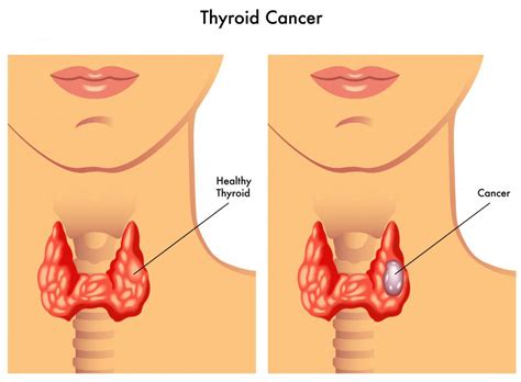 types  goiter  pictures