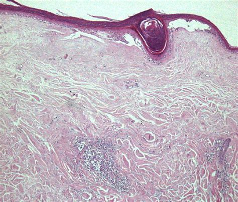 extragenital lichen sclerosus clinical dermoscopic