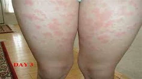 mild hiv rash excellent health information health digest