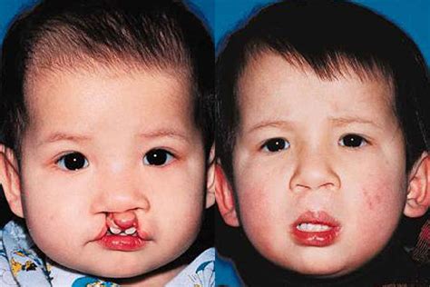 bilateral cleft lip gallery