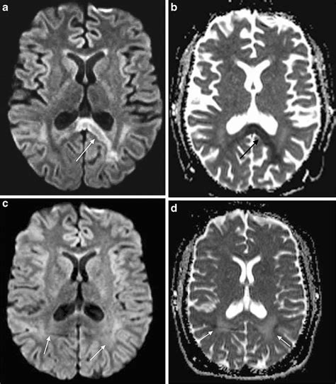 Methotrexate Associated Neurotoxicity In A 10 Year Old Girl With Acute