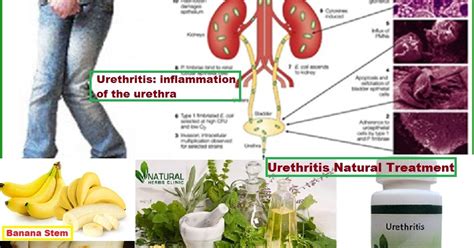 Urethritis Urethritis Natural Treatment