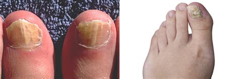 Fungal Nail Infections Fungal Diseases Cdc