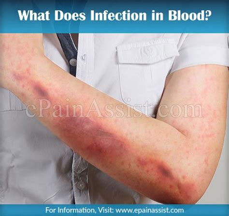infection  blood  sepsis     treated
