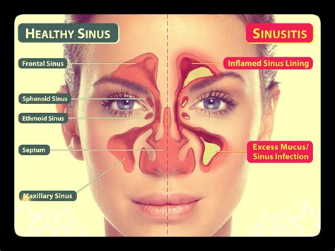 sinus infection austin family medicine