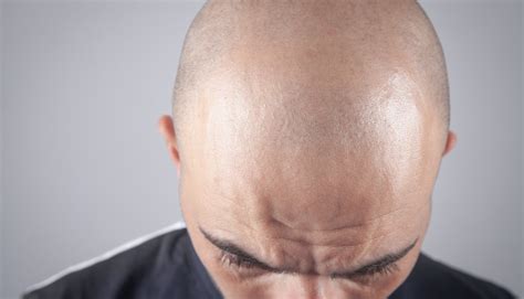 Bald White Men Seen As Less Attractive But No Difference For Black Men