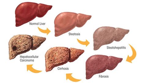 Cirrhosis Of The Liver Symptoms Causes Stages