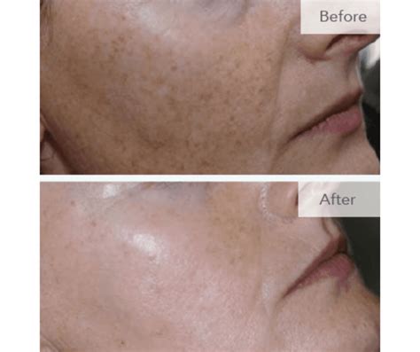 limelight laser skin treatments revive medical spa llc