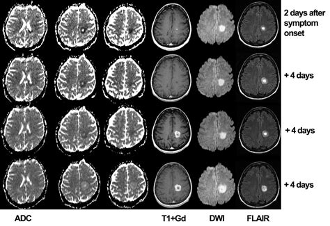 Reduced Diffusion In A Subset Of Acute Ms Lesions A Serial