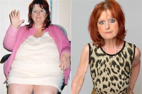 Starvation Fears Of Gastric Bypass Mum Who Can T Stop