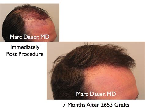 early growth post hair transplant procedure marc dauer md hair