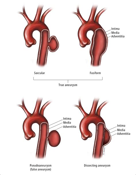 life expectancy  thoracic aortic aneurysm surgery good life