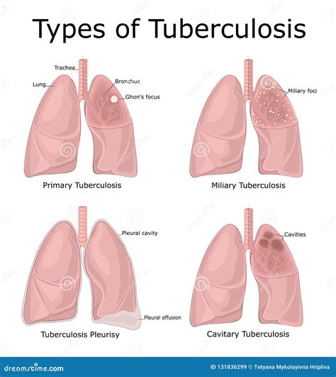 tuberculosis cartoons illustrations vector stock images