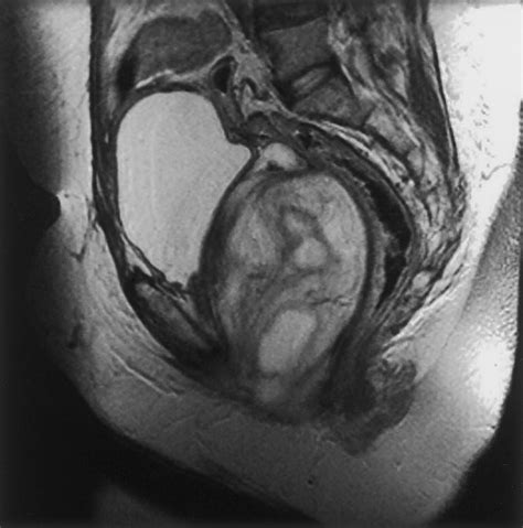 Mr Imaging Of Common And Uncommon Large Pelvic Masses Radiographics
