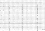 Sinus Arrhythmia Bradycardia Float Nurse Shortest Rhythm Grater Sec Interval Irregular Longest Difference Between Than There sketch template