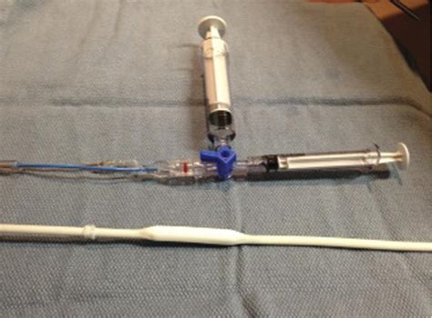 endoluminal dilation technique to remove “stuck” tunneled hemodialysis