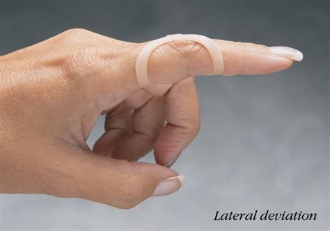 point oval  finger splints north coast medical