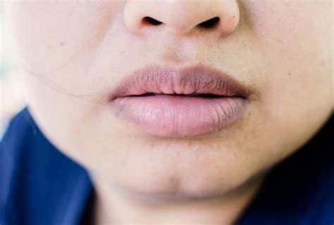 dark lips   treatment options emedihealth