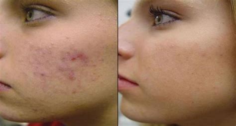 natural home remedies  pimples overnight updated