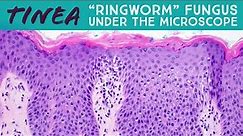 "Ringworm" under the microscope (tinea dermatophytosis fungal folliculitis Majocchi pathology)