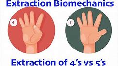 Extraction of 4's vs 5's- Premolar Extraction Biomechanics
