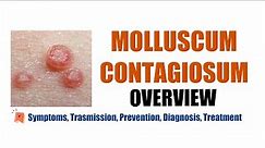 Molluscum Contagiosum (Water warts)- Symptoms, transmission, prevention, diagnosis, treatment
