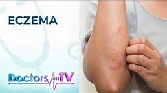 Eczema: Symptoms, Causes, and Treatment | Doctors on TV