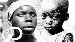 The Eradication Of Smallpox | Invisible Killers