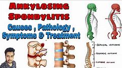 Ankylosing Spondylitis - Cause - Pathology - Symptoms - Treatment (Nursing Lecture in Hindi MSN 1)