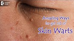 AMAZING WAYS TO GET RID OF SKIN WARTS | Skin Wart Removal Tips - Dr.Nischal K | Doctors' Circle