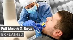 Dental X-Ray Full Mouth Series (FMX) Explained