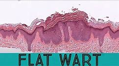 Flat wart under the microscope (verruca plana) pathology dermpath dermatology dermatopathology