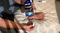 How to remove a plantar wart at home, Compound W freeze off wart removal system used on my foot