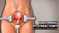 Abdominal Hysterectomy: Everything You Need to Know