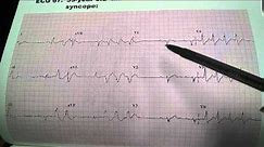 Cardiomegaly Syncope ECG EKG electrocardiogram Uri Ben-Zur MD