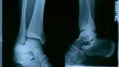 Złamanie kości udowej - przyczyny, objawy i leczenie