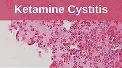 Ketamine Cystitis - Pathology mini tutorial