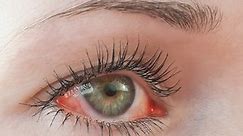 Czerwone oczy mogą być objawem choroby. O czym mogą świadczyć zaczerwienione oczy i jak pozbyć się tego problemu? Wypróbuj domowe sposoby