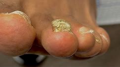 Why Is My Toenail THICK, YELLOW & CRUMBLY?!
