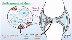 Gout - Mechanisms & Treatment
