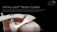 Infinity-Lock Button System Animation
