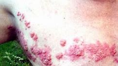 I Have Shingles - 5 things you can do to combat Herpes Zoster (shingles virus)