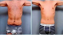 Male Tummy Tuck | Case Study | Dr. Sterry