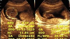 About 16 weeks of pregnancy Sonographic prediction