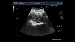 Ultrasound Video showing Cervicitis with dilated cervix uteri.