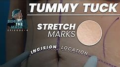 Tummy Tuck: Incisions and Stretch Marks