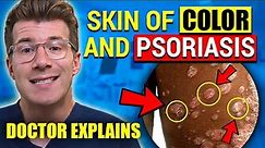 Skin of Color and Psoriasis: Visual Signs & Symptoms| Doctor Explains