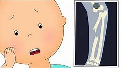 🦴 Caillou Breaks a Bone 🤕 | Caillou's New Adventures