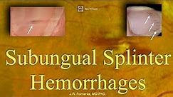 Subungual Splinter Hemorrhages. Bacterial Endocarditis.