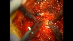 Lumbar Laminectomy Video